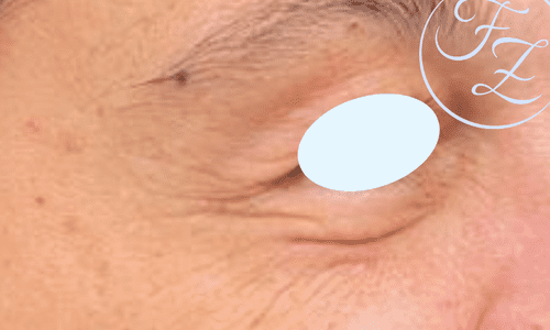 Botox dopo 1