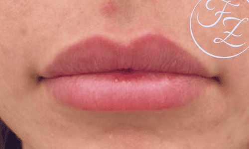 Filler labbra dopo